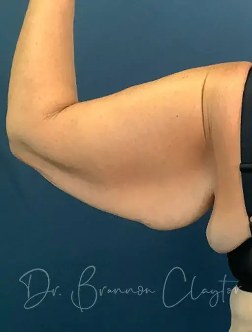 CoolSculpting before at Claytor Noone Plastic Surgery: Dr. R. Brannon Claytor in Bryn Mawr, PA