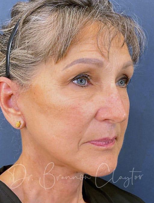 Facelift after at Claytor Noone Plastic Surgery: Dr. R. Brannon Claytor in Bryn Mawr, PA