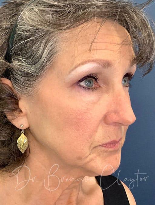 Facelift before at Claytor Noone Plastic Surgery: Dr. R. Brannon Claytor in Bryn Mawr, PA
