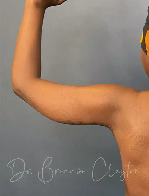 CoolSculpting after at Claytor Noone Plastic Surgery: Dr. R. Brannon Claytor in Bryn Mawr, PA