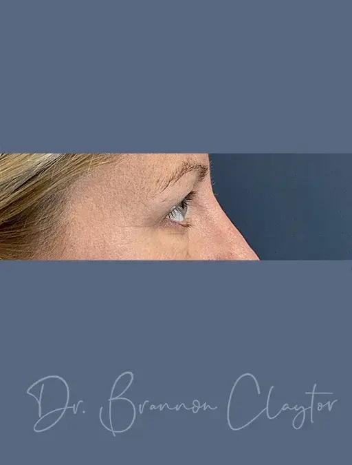 Blepharoplasty before at Claytor Noone Plastic Surgery: Dr. R. Brannon Claytor in Bryn Mawr, PA