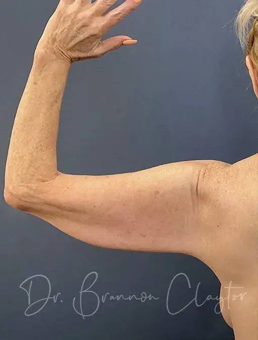 Arm Lift before at Claytor Noone Plastic Surgery: Dr. R. Brannon Claytor in Bryn Mawr, PA