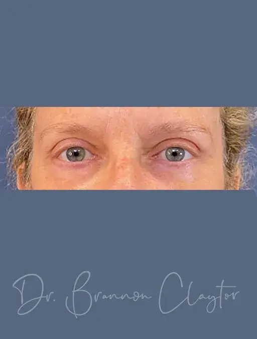 Blepharoplasty after at Claytor Noone Plastic Surgery: Dr. R. Brannon Claytor in Bryn Mawr, PA