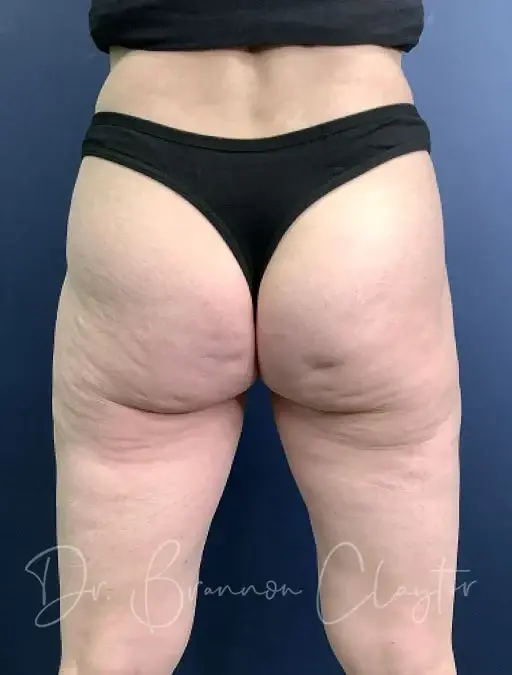 Claytor Noone Plastic Surgery: Dr. R. Brannon Claytor liposuction after — Bryn Mawr, PA
