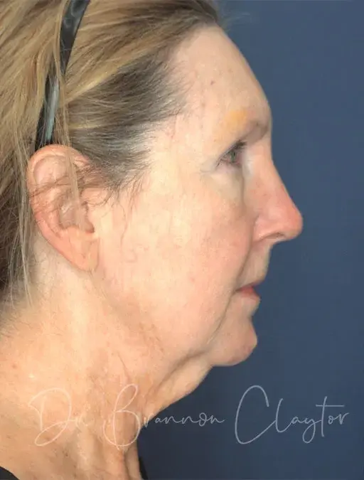 Neck Lift before at Claytor Noone Plastic Surgery: Dr. R. Brannon Claytor in Bryn Mawr, PA