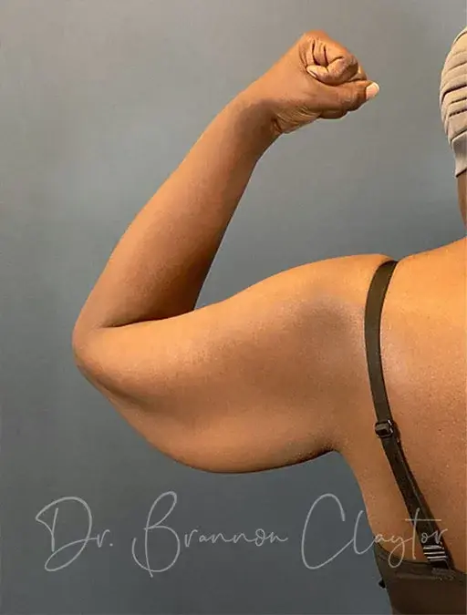 CoolSculpting before at Claytor Noone Plastic Surgery: Dr. R. Brannon Claytor in Bryn Mawr, PA