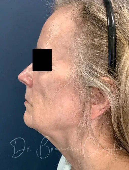 Facelift before at Claytor Noone Plastic Surgery: Dr. R. Brannon Claytor in Bryn Mawr, PA