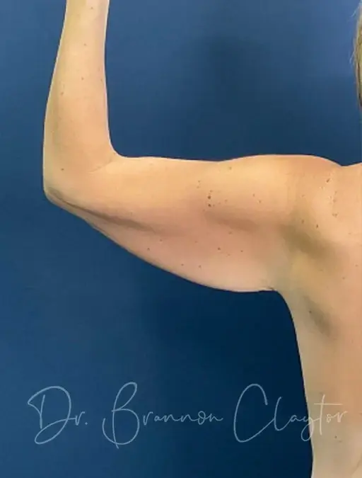 CoolSculpting before at Claytor Noone Plastic Surgery: Dr. R. Brannon Claytor in Bryn Mawr, PA