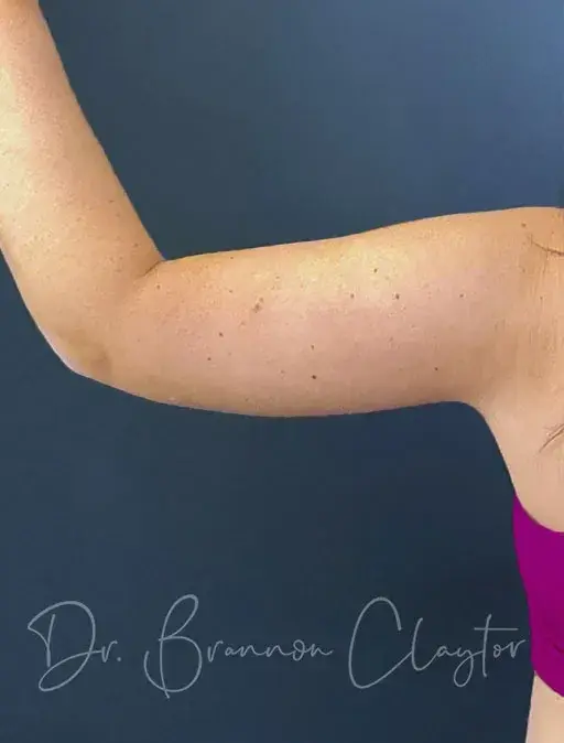 CoolSculpting after at Claytor Noone Plastic Surgery: Dr. R. Brannon Claytor in Bryn Mawr, PA