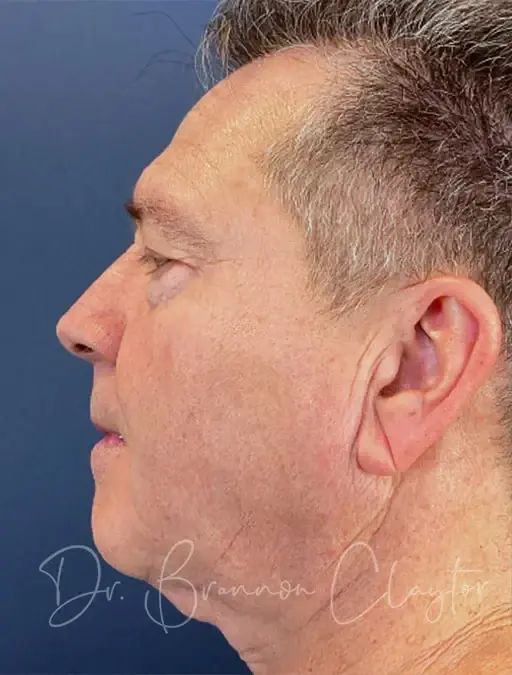 Blepharoplasty before at Claytor Noone Plastic Surgery: Dr. R. Brannon Claytor in Bryn Mawr, PA