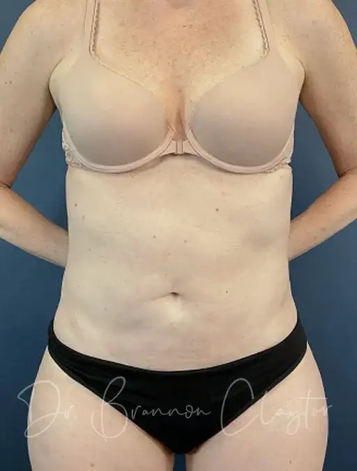 Claytor Noone Plastic Surgery: Dr. R. Brannon Claytor liposuction after — Bryn Mawr, PA