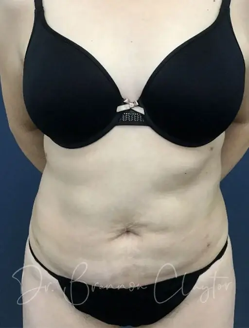 Liposuction after at Claytor Noone Plastic Surgery: Dr. R. Brannon Claytor in Bryn Mawr, PA