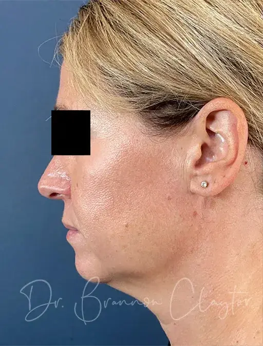Neck Lift before at Claytor Noone Plastic Surgery: Dr. R. Brannon Claytor in Bryn Mawr, PA