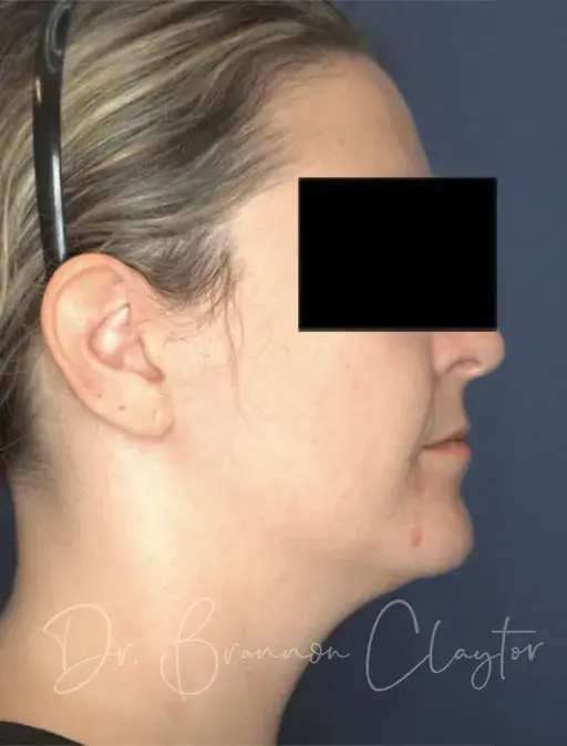 Neck Lift before at Claytor Noone Plastic Surgery: Dr. R. Brannon Claytor in Bryn Mawr, PA