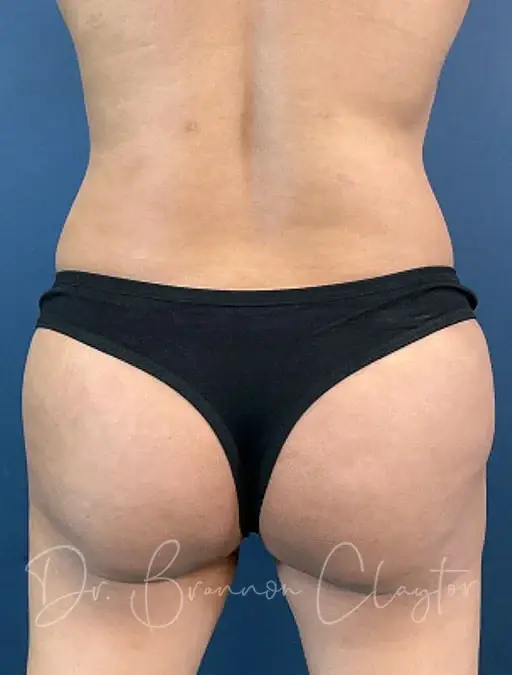 Brazilian Butt Lift after at Claytor Noone Plastic Surgery: Dr. R. Brannon Claytor in Bryn Mawr, PA