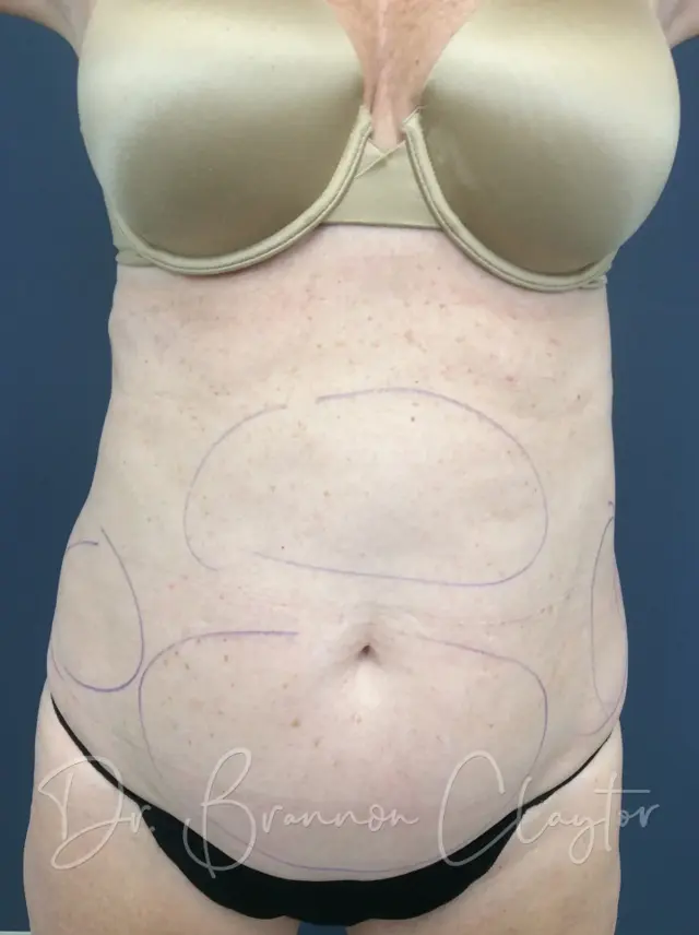 Liposuction before at Claytor Noone Plastic Surgery: Dr. R. Brannon Claytor in Bryn Mawr, PA