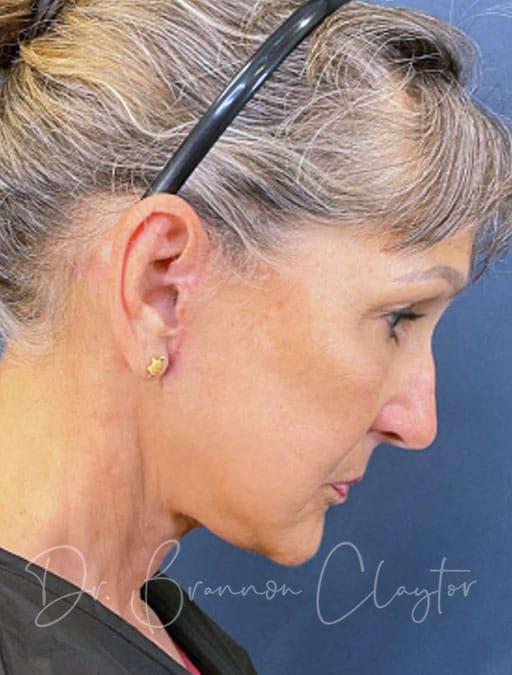 Claytor Noone Plastic Surgery: Dr. R. Brannon Claytor facelift after — Bryn Mawr, PA