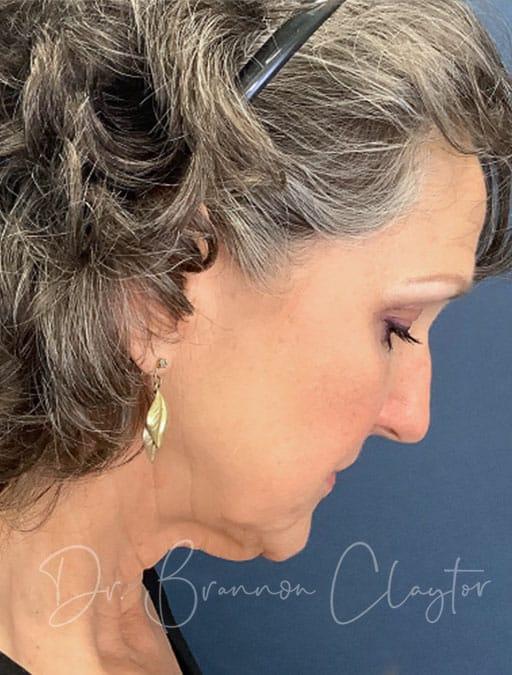 Facelift before at Claytor Noone Plastic Surgery: Dr. R. Brannon Claytor in Bryn Mawr, PA