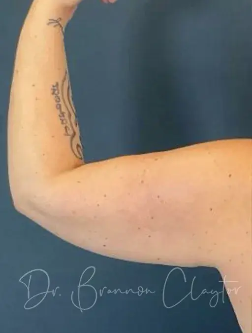 Arm Lift before at Claytor Noone Plastic Surgery: Dr. R. Brannon Claytor in Bryn Mawr, PA