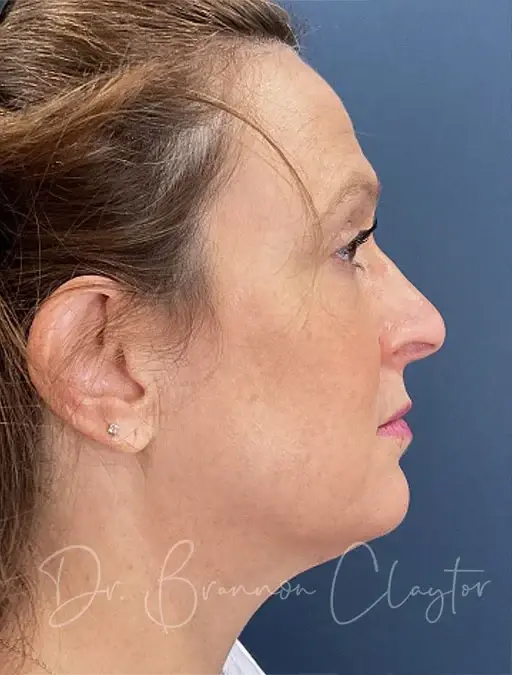 Neck Lift before at Claytor Noone Plastic Surgery: Dr. R. Brannon Claytor in Bryn Mawr, PA