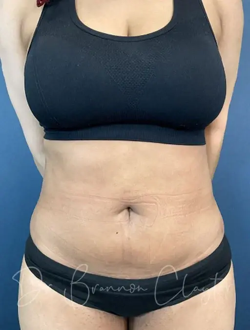 Liposuction after at Claytor Noone Plastic Surgery: Dr. R. Brannon Claytor in Bryn Mawr, PA