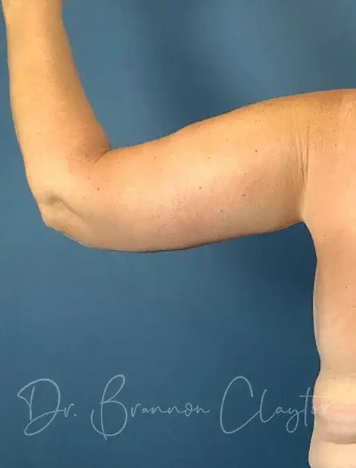 CoolSculpting after at Claytor Noone Plastic Surgery: Dr. R. Brannon Claytor in Bryn Mawr, PA