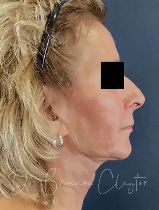 Neck Lift after at Claytor Noone Plastic Surgery: Dr. R. Brannon Claytor in Bryn Mawr, PA