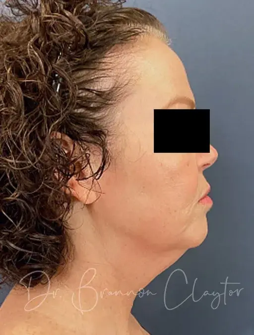 Facelift before at Claytor Noone Plastic Surgery: Dr. R. Brannon Claytor in Bryn Mawr, PA