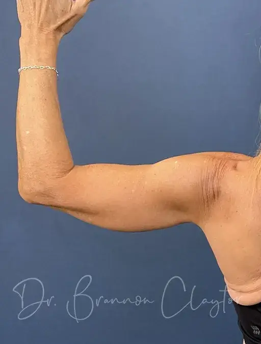 Arm Lift after at Claytor Noone Plastic Surgery: Dr. R. Brannon Claytor in Bryn Mawr, PA