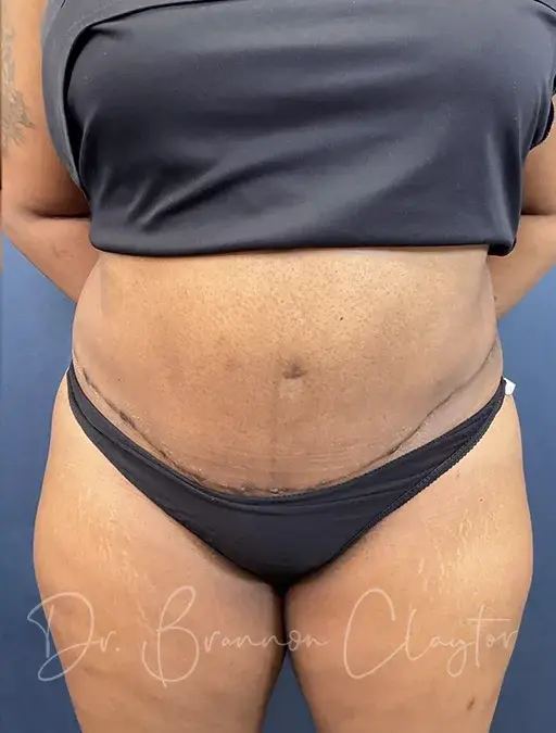 Claytor Noone Plastic Surgery: Dr. R. Brannon Claytor tummy tuck after — Bryn Mawr, PA