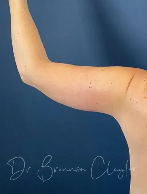 CoolSculpting after at Claytor Noone Plastic Surgery: Dr. R. Brannon Claytor in Bryn Mawr, PA