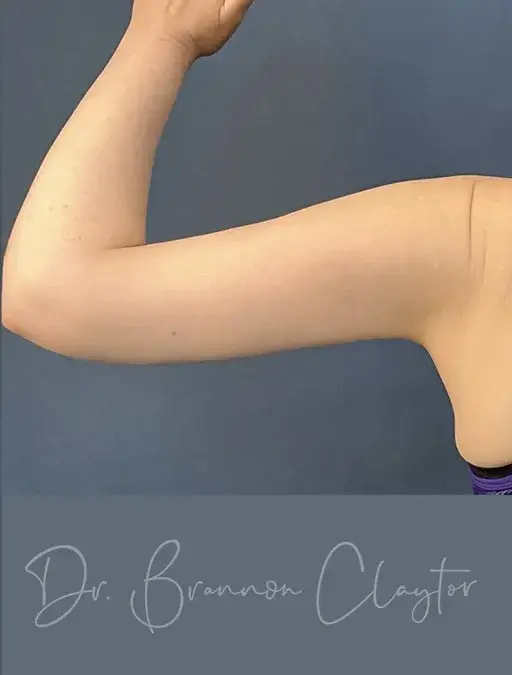 Arm Lift after at Claytor Noone Plastic Surgery: Dr. R. Brannon Claytor in Bryn Mawr, PA