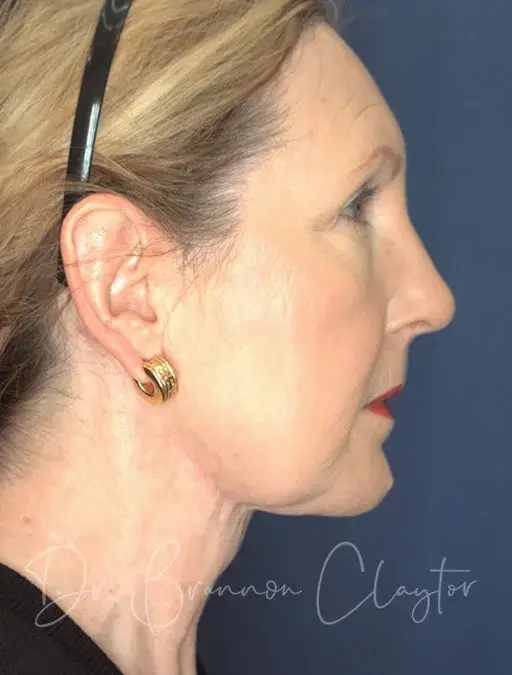 Neck Lift after at Claytor Noone Plastic Surgery: Dr. R. Brannon Claytor in Bryn Mawr, PA