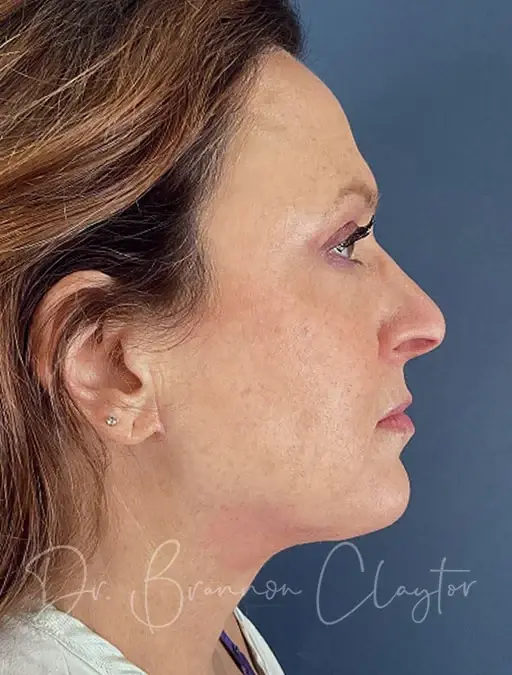 Neck Lift after at Claytor Noone Plastic Surgery: Dr. R. Brannon Claytor in Bryn Mawr, PA