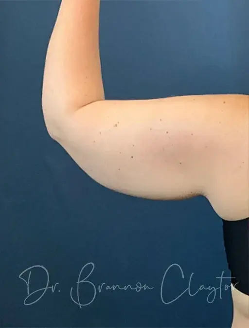 CoolSculpting before at Claytor Noone Plastic Surgery: Dr. R. Brannon Claytor in Bryn Mawr, PA