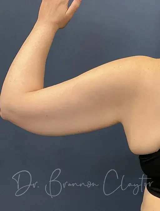 Arm Lift before at Claytor Noone Plastic Surgery: Dr. R. Brannon Claytor in Bryn Mawr, PA