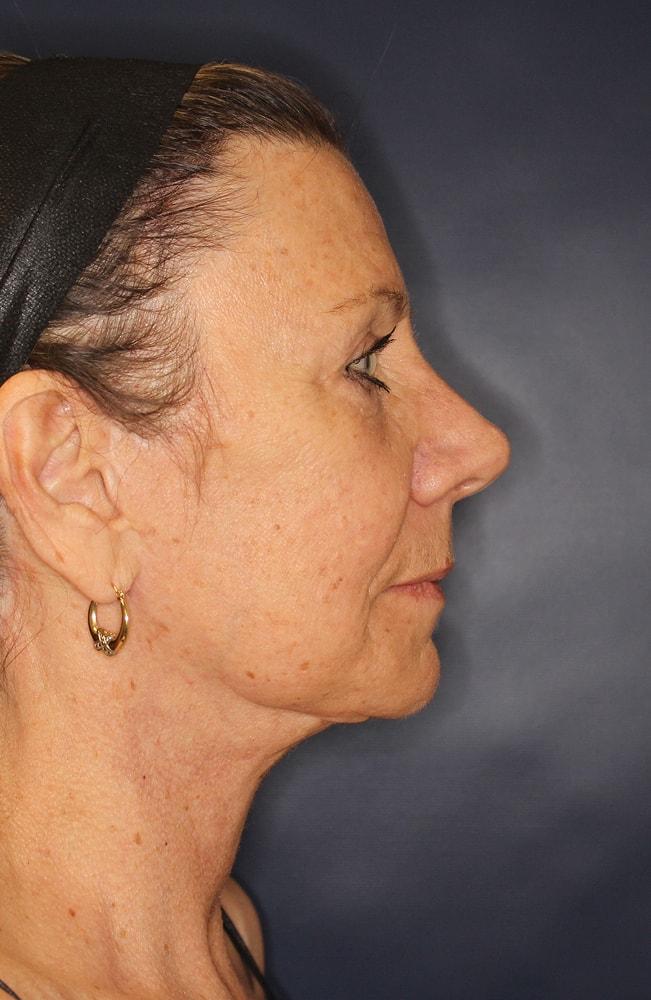 Sadrian Plastic Surgery, Laser & Skin Care Institute of San Diego blepharoplasty after — San Diego, CA
