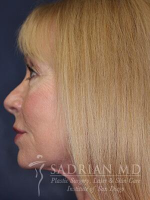 Sadrian Plastic Surgery, Laser & Skin Care Institute of San Diego facelift after — San Diego, CA