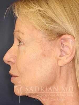 Facelift before at Sadrian Plastic Surgery, Laser & Skin Care Institute of San Diego in San Diego, CA