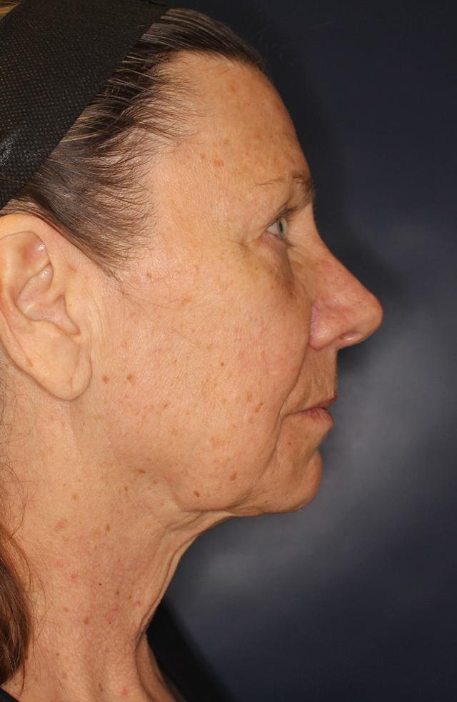 Blepharoplasty before at Sadrian Plastic Surgery, Laser & Skin Care Institute of San Diego in San Diego, CA