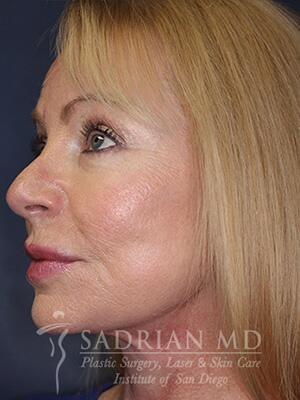 Sadrian Plastic Surgery, Laser & Skin Care Institute of San Diego facelift after — San Diego, CA