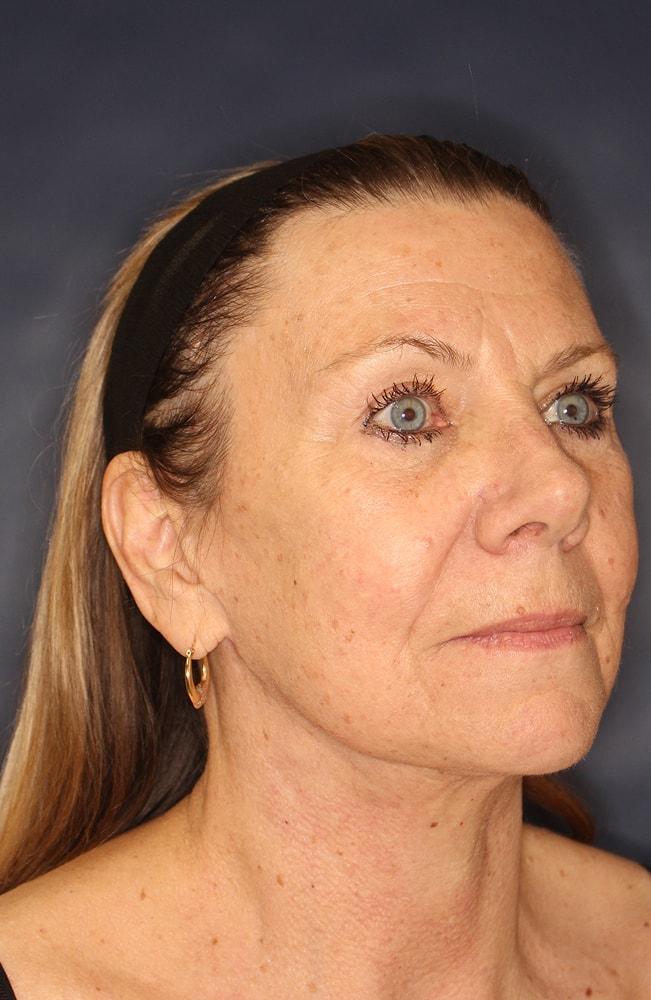 Sadrian Plastic Surgery, Laser & Skin Care Institute of San Diego blepharoplasty after — San Diego, CA