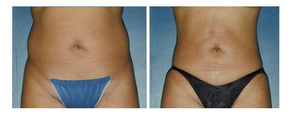 Mezrow Plastic Surgery (Craig Mezrow, MD) liposuction result — Bala Cynwyd, PA