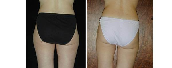 Mezrow Plastic Surgery (Craig Mezrow, MD) liposuction result — Bala Cynwyd, PA