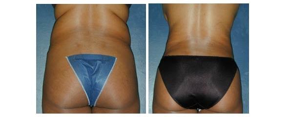 Mezrow Plastic Surgery (Craig Mezrow, MD) liposuction result — Bala Cynwyd, PA