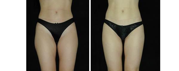 Mezrow Plastic Surgery (Craig Mezrow, MD) liposuction result — Bala Cynwyd, PA