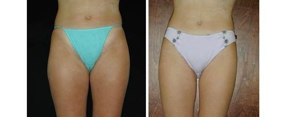 Mezrow Plastic Surgery (Craig Mezrow, MD) liposuction result — Bala Cynwyd, PA