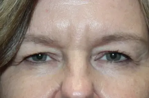 Blepharoplasty before at Still Canyon Plastics in Holladay, UT