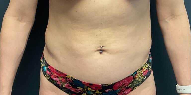 Jeremy Williams, MD liposuction after โ Lone Tree, CO