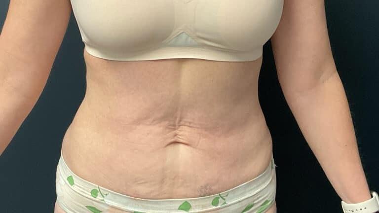 Jeremy Williams, MD liposuction after — Lone Tree, CO